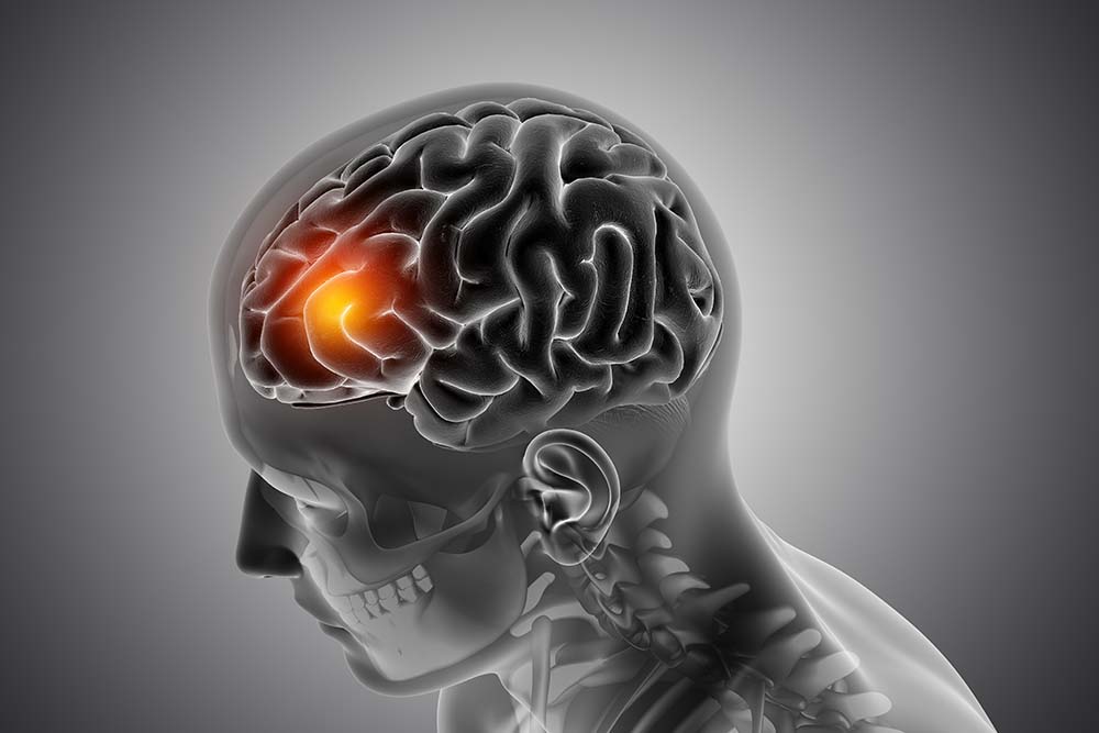 Μηνιγγίωμα: Ο πιο συχνός τύπος πρωτοπαθούς όγκου του εγκεφάλου